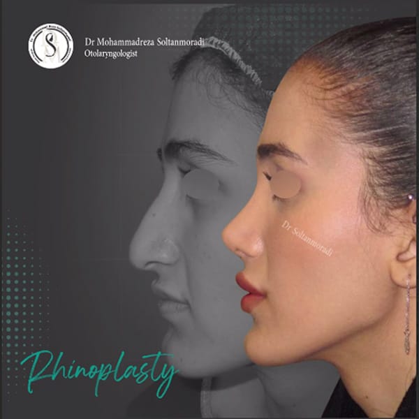 جراحی بینی طبیعی - دکتر سلطان مرادی