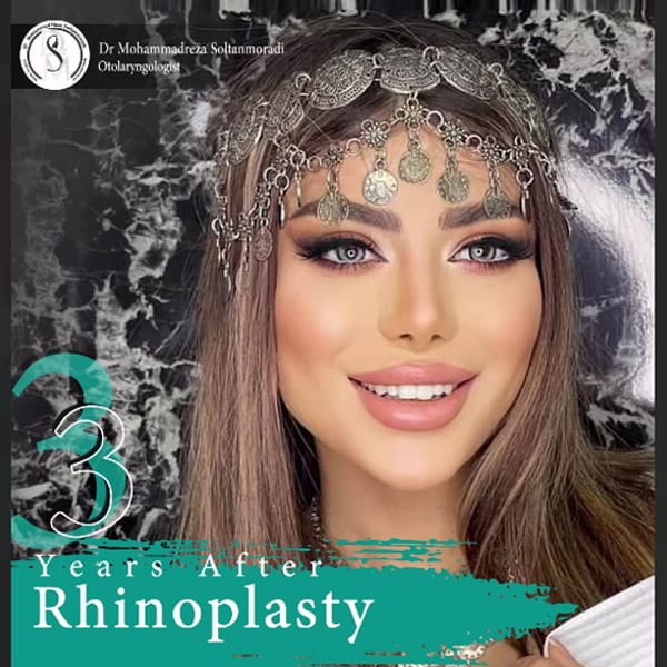 عکس نمونه کار از جراحی بینی - دکتر سلطان مرادی - ورم بینی بعد از عمل