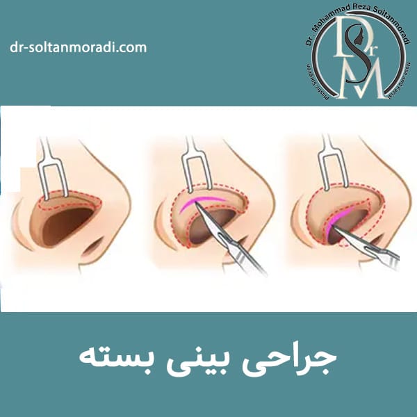 جراحی بینی بسته https://dr-soltanmoradi.com/