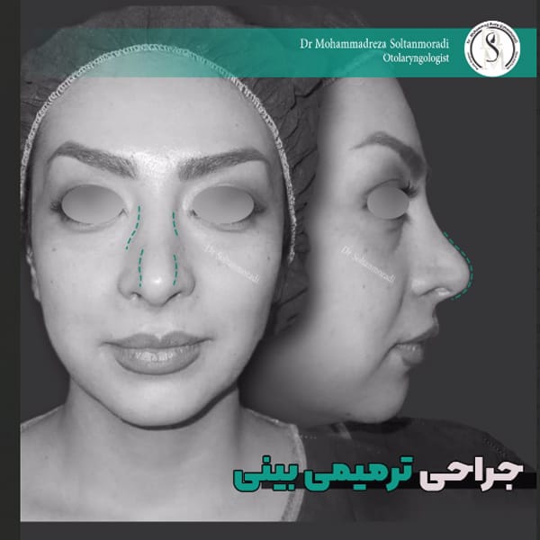 جراحی-بینی-ترمیمی