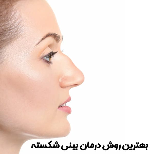 جراحی بینی شکسته