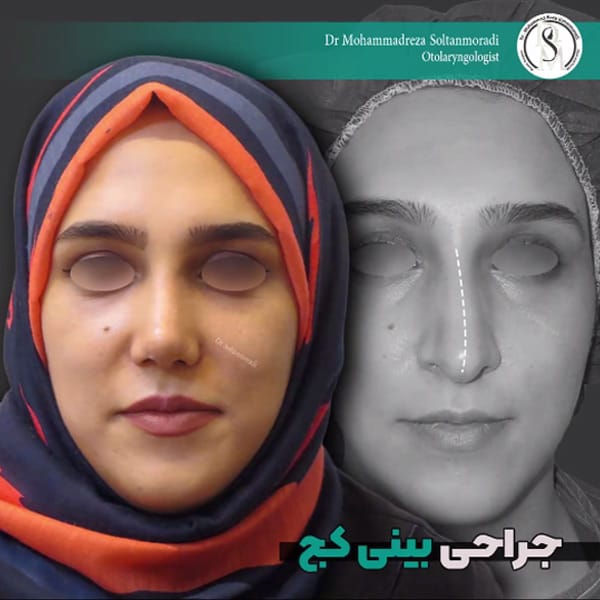 جراحی بینی کج - دکتر سلطان مرادی