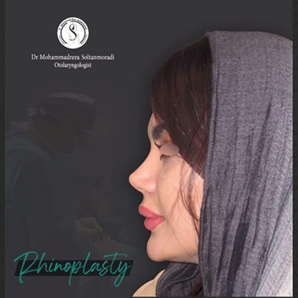 جراحی بینی فانتزی - دکتر سلطان مرادی