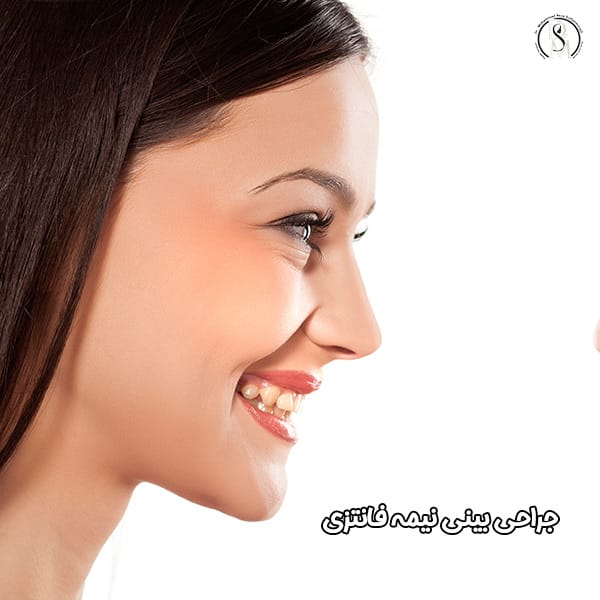 جراحی بینی نیمه فانتزی در تهران - دکتر سلطان مرادی