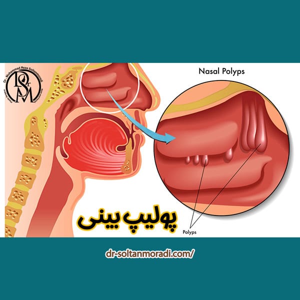 پولیپ بینی
https://dr-soltanmoradi.com/