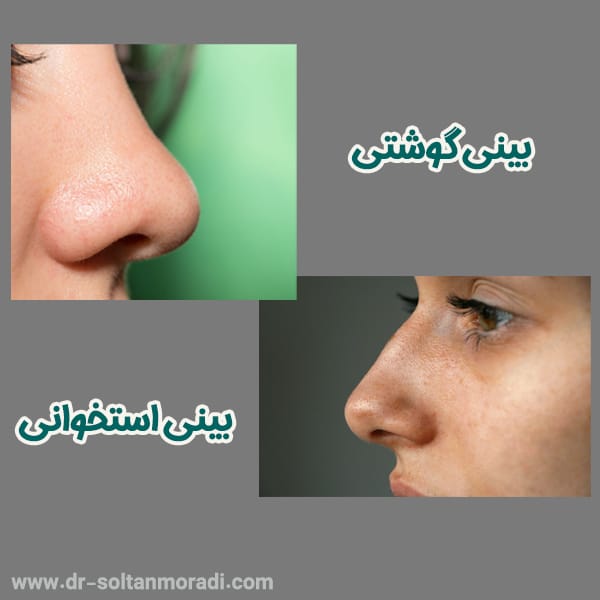 تفاوت بینی گوشتی و استخوانی - https://dr-soltanmoradi.com/