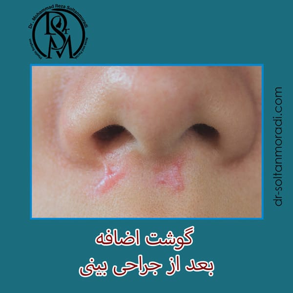 گوشت اضافه بعد از جراحی بینی https://dr-soltanmoradi.com/