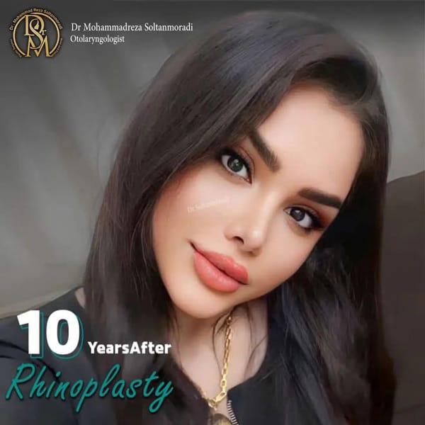rhinoplasty-28