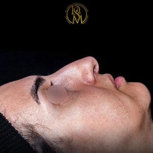جراحی بینی | دکتر سلطان مرادی