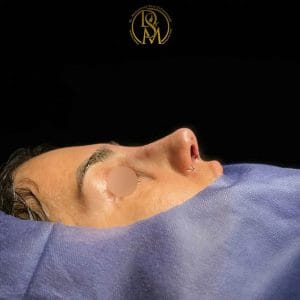 جراحی بینی | دکتر سلطان مرادی