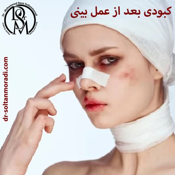 کبودی بعد از عمل بینی https://dr-soltanmoradi.com/
