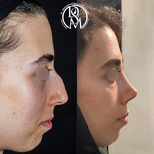 نمونه کار جراح بینی خوب تهران https://dr-soltanmoradi.com/