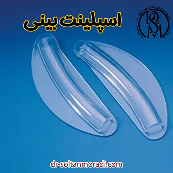 اسپلینت بینی https://dr-soltanmoradi.com/