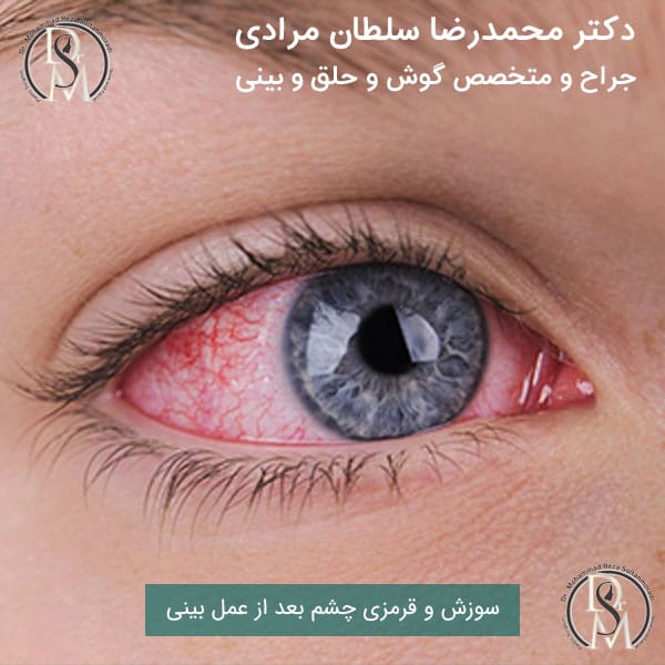 سوزش و قرمزی چشم بعد از عمل بینی