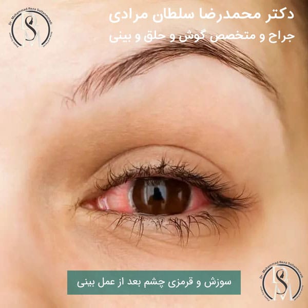 قرمزی و سوزش چشم بعد از عمل بینی