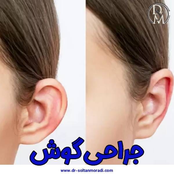 عکس جراحی گوش - دکتر محمدرضا سلطان مرادی