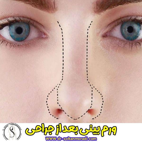 ورم بینی بعد عمل جراحی - دکتر محمدرضا سلطان مرادی